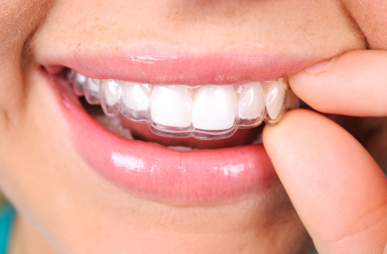 L’orthodontie en 5 questions
