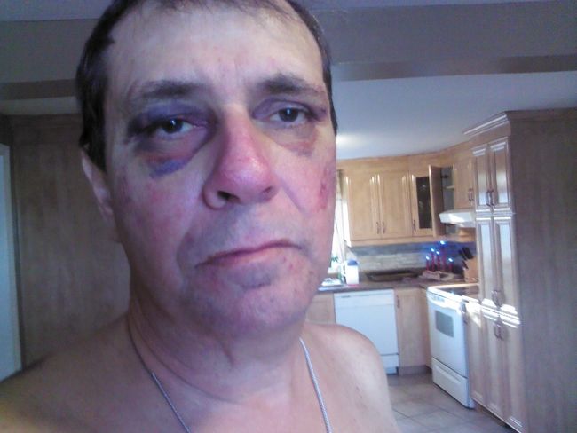 Raymond Laforce montre encore des signes évidents des blessures qu’il a subies lors de son arrestation.
