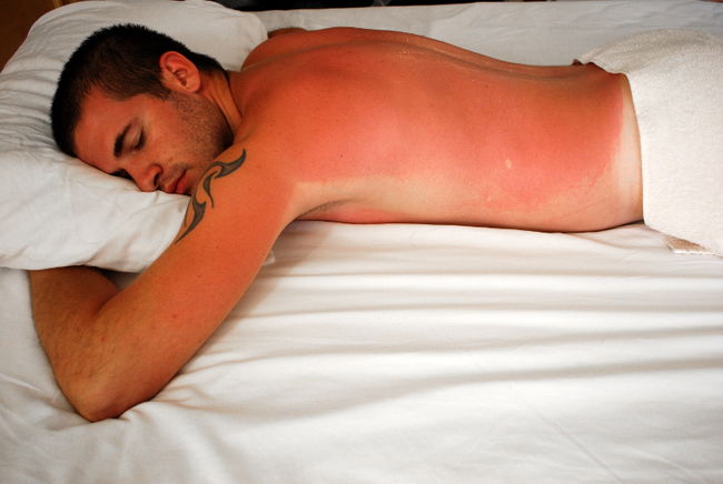 Les personnes surexposées aux rayons UV et celles qui subissent des coups de soleil fréquents lorsqu’elles sont jeunes sont plus à risque de développer un cancer de la peau.