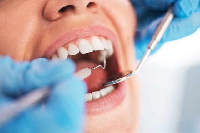 4 traitements efficaces de la carie
