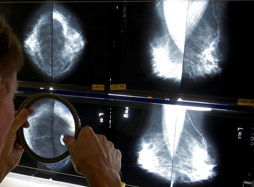 Cancer du sein: dépistage gratuit désormais élargi aux Québécoise de 70 à 74 ans