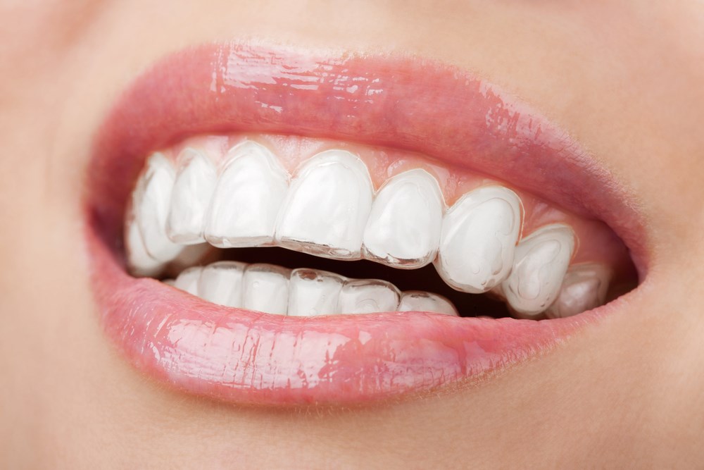 Les aligneurs transparents : une solution esthétique pour des dents droites
