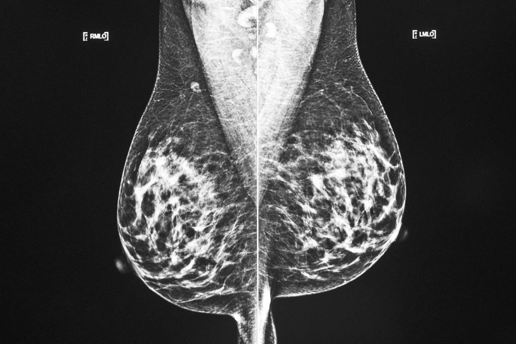 Une étude détaille l'association entre l'obésité et le cancer du sein