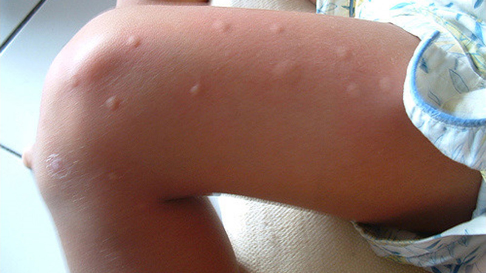 Comment bien se protéger contre les piqûres de moustiques?