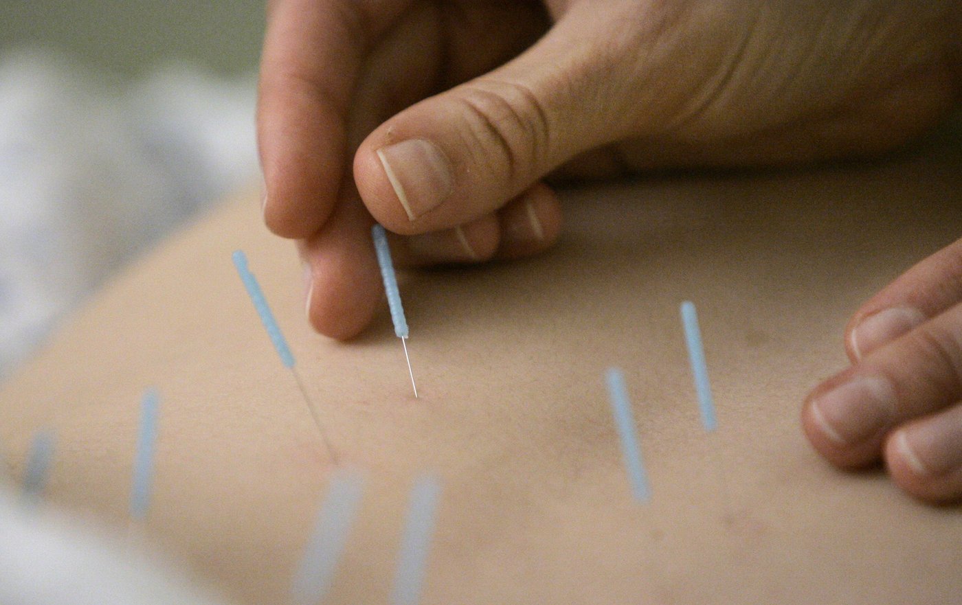 L'acupuncture peut soulager les maux de dos chroniques, montre une étude