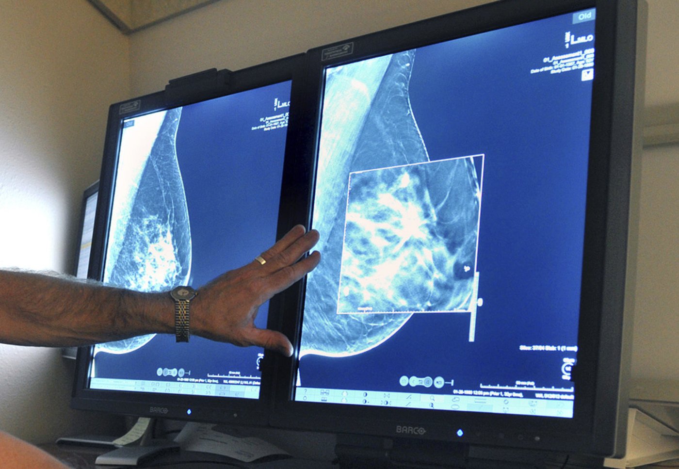 Cancer du sein: l'INESSS recommande le dépistage à 45 ans, mais pas tout de suite